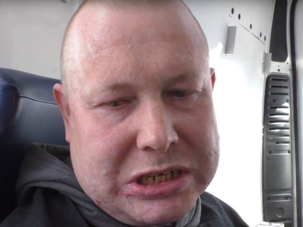 Скалічений у полоні терористів боєць АТО жорстко відповів кремлівському пропагандисту