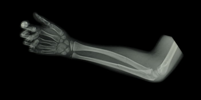 В житомирской школе не смогли помочь ученице со сломанной рукой