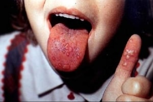 Лікарка розповіла, як уберегти дітей від вірусу Коксакі