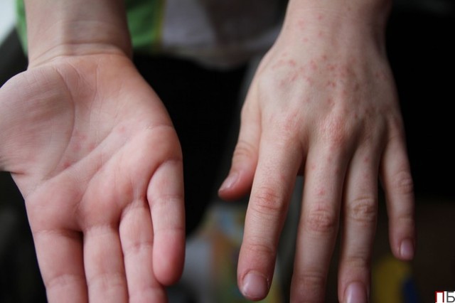 В Турции украинские туристы подхватили опасный вирус: в сети бьют тревогу