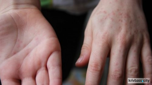 В Кривом Роге уже 14 человек попали в больницу с вирусом Коксаки
