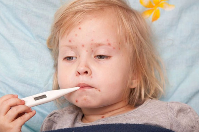 Заболеваемость корью в Киеве выросла в 5 раз