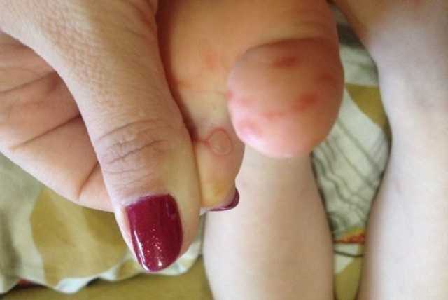 В Киеве родители бьют тревогу из-за заражения детей вирусом Коксаки в детсаду