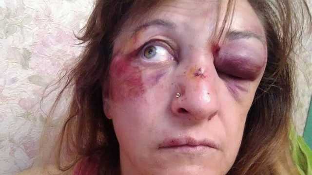 "Получила контузию обоих глаз". В Киеве врачей бьют ногами за отказ от взяток