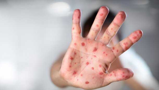 В Одессе не привитым от кори детям запретили ходить в школу