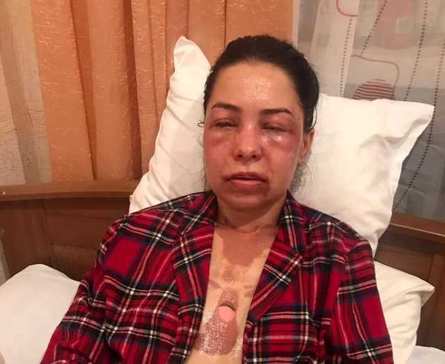 "Зрение повреждено": появились фото женщины, облитой кислотой экс-мужем в Днепре