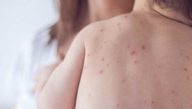 На Закарпатье 43 ребенка попали в больницу из-за кори