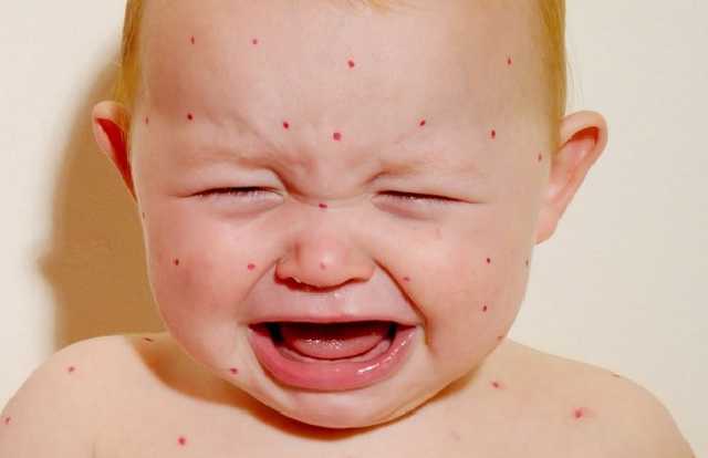 Вспышка кори: количество желающих вакцинироваться выросло в пять раз