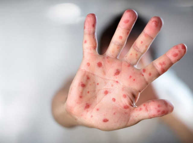 Родители не привитых от кори одесских детей собираются на забастовку