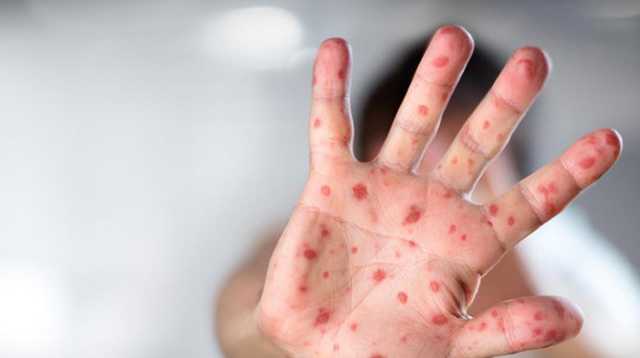 Вакцины от кори распределят между регионами на следующей неделе - Супрун