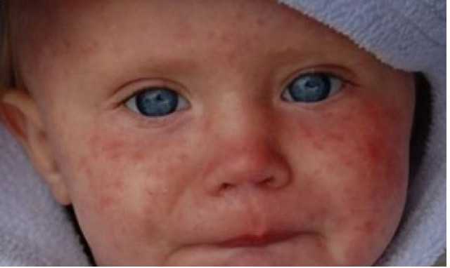 В Киевской области вспыхнули корь и ветрянка