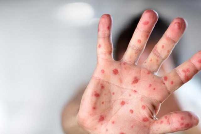 Корь в Украине - озвучена шокирующая статистика