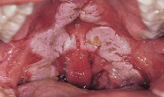"Путают с ангиной": в Украине зафиксирован третий случай смертельного заболевания