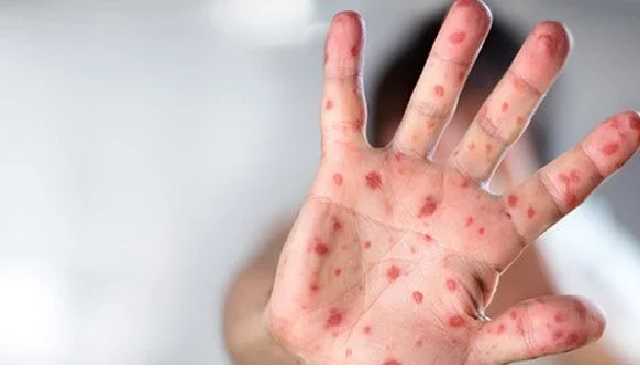 Число заболевших корью украинцев в разных регионах страны снова пошло в рост