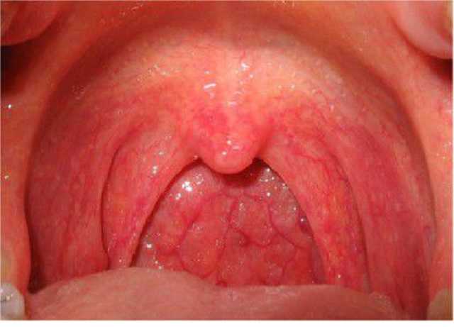 В Украине лабораторно подтвердили четвертый случай дифтерии