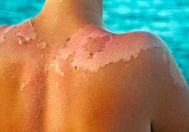 Солнечные ожоги: Супрун рассказала, что ни в коем случае нельзя делать