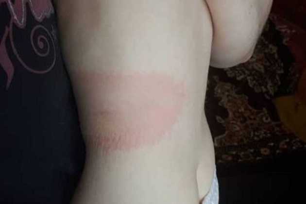 В Киеве клещи начали разносить смертельную заразу. Заболело уже 20 человек