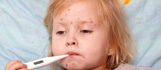 В Молдавии объявили "оранжевый" уровень угрозы из-за эпидемии кори