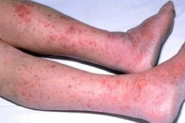 «Сгорела» за 4 часа. На Закарпатье от смертельной инфекции умер ребенок