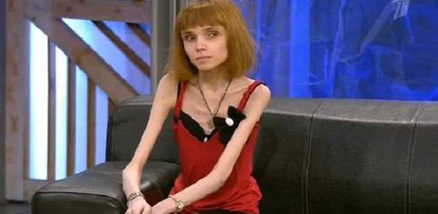 Худеющая россиянка снизила вес до 17 кг: умирающая выкладывает фото и видео