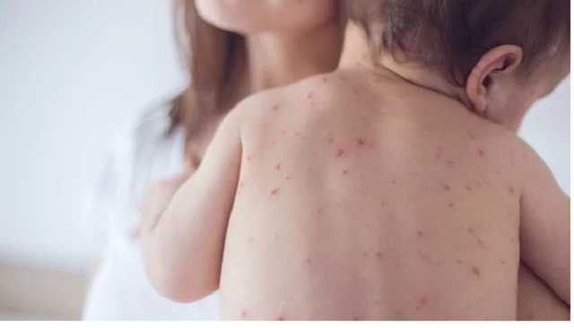 Температура 40 и душит кашель: в Украине опять вспыхнула опасная инфекция