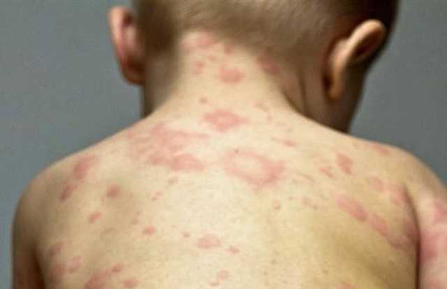 Во Львове от кори скончался трехлетний ребенок