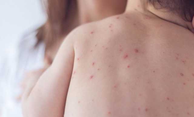 За последнюю неделю в Киеве 44 человека заболели корью