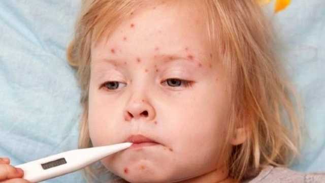 Минздрав: за последнюю неделю в Украине корью заболели 1,7 тысячи человек