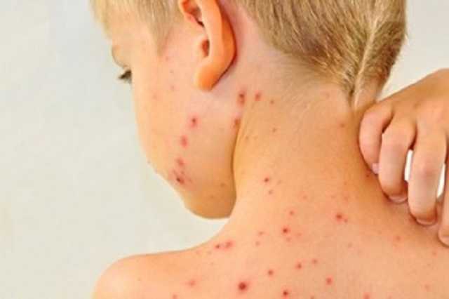 У Луцьку за три тижні понад 100 осіб захворіли на кір