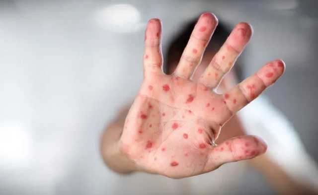 Украина на пороге эпидемии кори: как защититься от опасной болезни