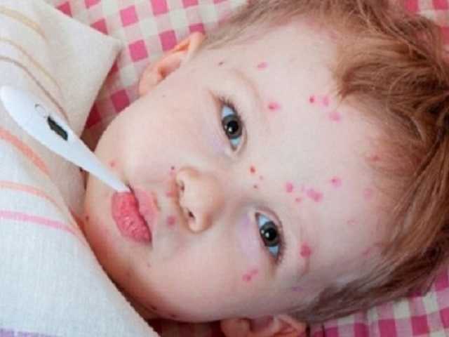 В Черновицкой области не привитым от кори детям запретили посещать школы