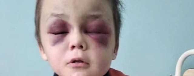 За жестокое избиение 6-летнего мальчика на Винниччине задержали его мачеху