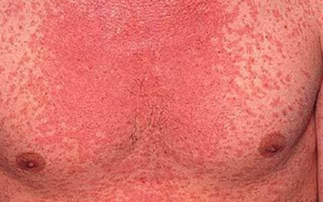 В Мелитополе заболела корью семья из шести человек