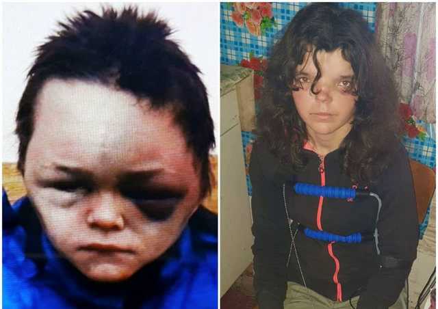 Глаза черные от побоев: вскрылась жуткая правда об избиении 6-летнего ребенка на Винничине