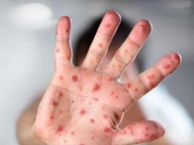 Украина возглавила рейтинг стран по заболеваемости корью - ЮНИСЕФ