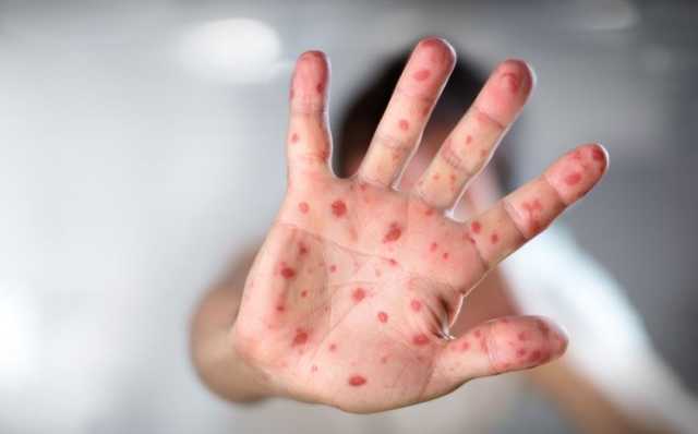 В Хмельницкой области младенец умер от кори