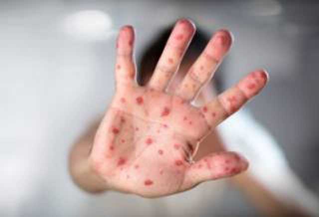 В одном из санаториев Бердянска зафиксирована вспышка кори