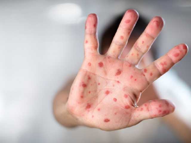 В тернопольском колледже корью одновременно заболели 16 человек