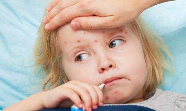 На Киевщине бушует корь