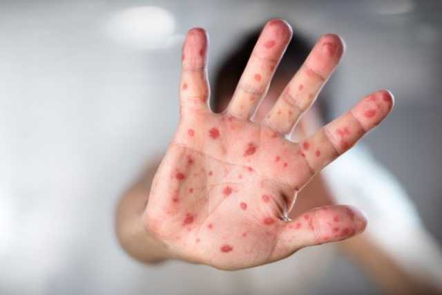 Почти 1400 украинцев заболели корью за одну неделю