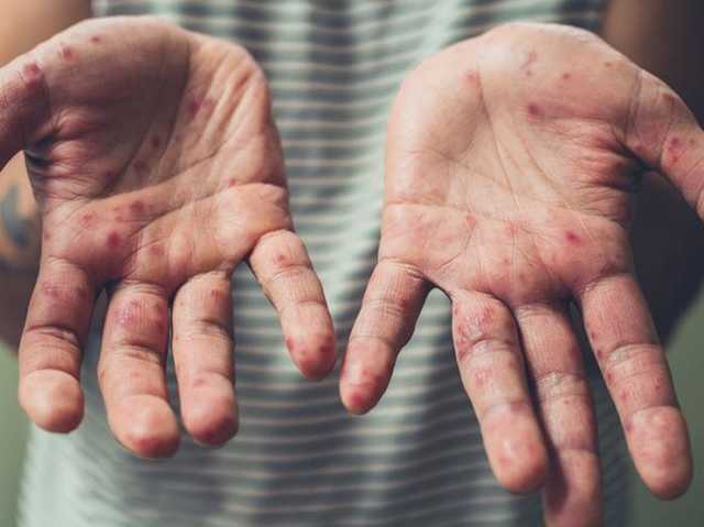 За неделю в Украине тысяча человек заболела корью