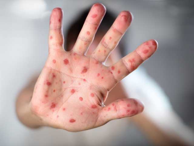 20 жителей Одесской области заболели корью