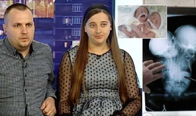 Прожили только 8 дней: появилось первое фото сиамских близнецов из Черновцов