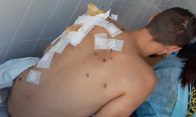 Атака беспилотника с территории РФ: Появились фото ранений бойца ВСУ