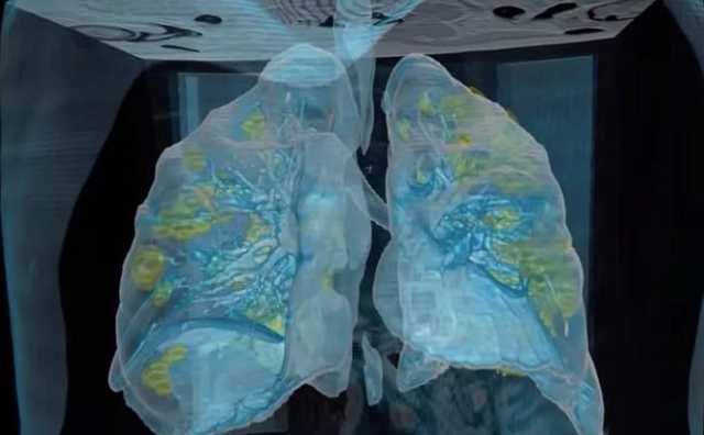 Как коронавирус уничтожает легкие: врачи показали новое видео