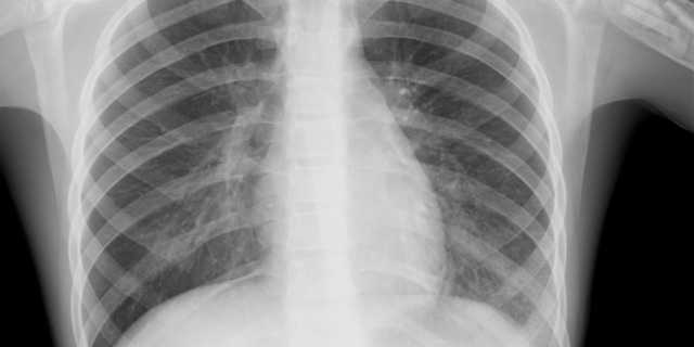 В области без COVID-19 вспышка пневмонии: число больных украинцев увеличилось в 18 раз