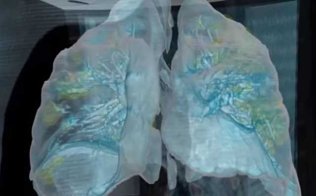 "Убивает" за два дня: инфекционист рассказала, как коронавирус поражает легкие