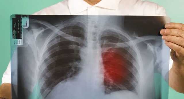 В мире сообщили о первой смерти от повторного заражения коронавирусом