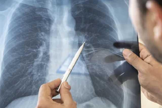 У коронавируса заподозрили новый симптом: превращает легкие в "желе"