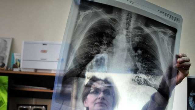 В Украине за месяц обнаружили около тысячи новых больных туберкулезом